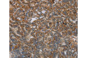 Immunohistochemistry of Human liver cancer using HSD17B14 Polyclonal Antibody at dilution of 1:40
