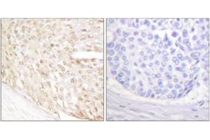 Immunohistochemistry analysis of paraffin-embedded human breast carcinoma tissue, using p18 INK Antibody. (P18 INK Antikörper  (AA 111-160))