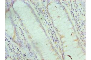 Immunohistochemistry of paraffin-embedded human colon cancer using ABIN7153695 at dilution of 1:100 (FABP6 Antikörper  (AA 1-128))