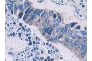 DAB staining on IHC-P; Samples: Human Colorectal cancer Tissue (PCOLCE Antikörper  (AA 315-437))