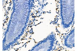 ABIN6257997 and ABIN6273474 at 1/100 staining Human colorectal cancer by IHC-P. (CXCR5 Antikörper  (N-Term))