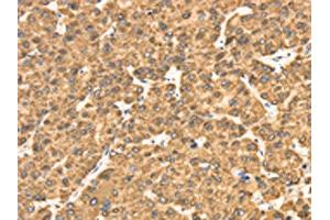 The image on the left is immunohistochemistry of paraffin-embedded Human liver cancer tissue using ABIN7130945(RRBP1 Antibody) at dilution 1/25, on the right is treated with fusion protein. (RRBP1 Antikörper)