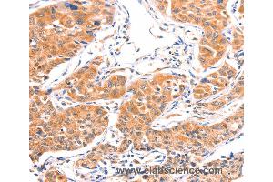 Immunohistochemistry of Human lung cancer using AMPD1 Polyclonal Antibody at dilution of 1:80 (AMPD1 Antikörper)