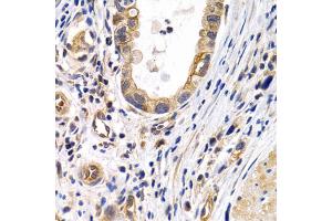 Immunohistochemistry of paraffin-embedded human gastric cancer using PTGIR antibody. (Prostacyclin Receptor Antikörper)