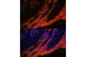 Immunofluorescence analysis of human skin cancer using IL1RA Rabbit mAb (ABIN7267971) at dilution of 1:100 (40x lens). (IL1RN Antikörper)