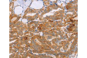 Immunohistochemistry of Human cervical cancer using CARD6 Polyclonal Antibody at dilution of 1:60