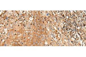 Immunohistochemistry of paraffin-embedded Human cervical cancer tissue using BAG3 Polyclonal Antibody at dilution of 1:35(x200) (BAG3 Antikörper)