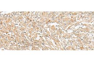 Immunohistochemistry of paraffin-embedded Human liver cancer tissue using GIPC1 Polyclonal Antibody at dilution of 1:50(x200) (GIPC1 Antikörper)