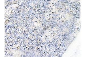 ABIN6255773 and ABIN6267263 at 1/100 staining human melanoma by IHC-P. (EGFR Antikörper  (pTyr1086, pTyr1110))