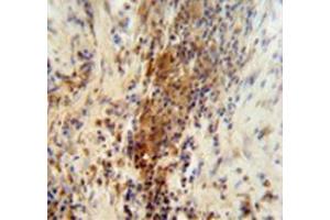 Immunohistochemistry analysis in human lung carcinoma (Formalin-fixed, Paraffin-embedded) using DNAJC11  Antibody (N-term), followed by peroxidase conjugated secondary antibody and DAB staining. (DNAJC11 Antikörper  (N-Term))