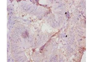 Immunohistochemistry of paraffin-embedded human colon cancer using ABIN7177698 at dilution of 1:10 (AMH Antikörper  (AA 450-552))
