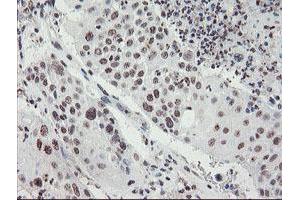 Immunohistochemical staining of paraffin-embedded Carcinoma of Human lung tissue using anti-MLF2 mouse monoclonal antibody. (MLF2 Antikörper)
