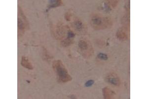 Immunohistochemistry (IHC) image for anti-Melanoma Associated Chondroitin Sulfate Proteoglycan (MCSP) (AA 1135-1444) antibody (ABIN1174256)