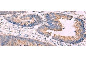 Immunohistochemistry of paraffin-embedded Human colorectal cancer tissue using KCNN3 Polyclonal Antibody at dilution of 1:40(x200) (KCNN3 Antikörper)