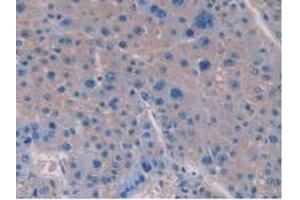 IHC-P analysis of Human Liver Cancer Tissue, with DAB staining. (IL-15 Antikörper  (AA 50-162))