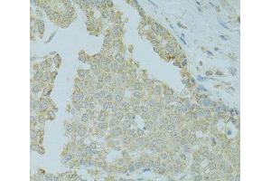 Immunohistochemistry of paraffin-embedded Human colon carcinoma using MTFP1 Polyclonal Antibody at dilution of 1:100 (40x lens). (Mtfp1 Antikörper)
