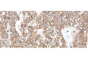 Immunohistochemistry of paraffin-embedded Human gastric cancer tissue using RNF111 Polyclonal Antibody at dilution of 1:50(x200) (RNF111 Antikörper)