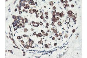Immunohistochemical staining of paraffin-embedded Adenocarcinoma of Human colon tissue using anti-PFKP mouse monoclonal antibody. (PFKP Antikörper)