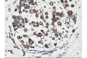 Immunohistochemical staining of paraffin-embedded Adenocarcinoma of Human colon tissue using anti-PFKP mouse monoclonal antibody.