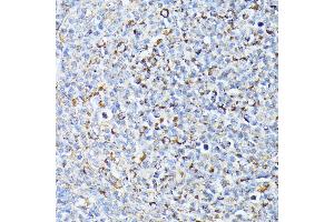 Immunohistochemistry of paraffin-embedded Human lymph node tumors using TP53I11 antibody (ABIN6131365, ABIN6149418, ABIN6149419 and ABIN6216636) at dilution of 1:100 (40x lens). (TP53I11 Antikörper  (AA 1-70))