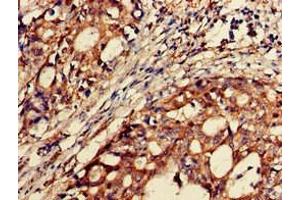 Immunohistochemistry of paraffin-embedded human gastric cancer using ABIN7145535 at dilution of 1:100 (BACE2 Antikörper  (AA 84-157))