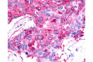 Anti-TPRA1 / GPR175 antibody IHC of human Breast, Carcinoma. (GPR175 Antikörper  (Cytoplasmic Domain))