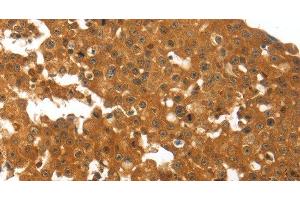 Immunohistochemistry of paraffin-embedded Human breast cancer using TNFRSF11B Polyclonal Antibody at dilution of 1:30 (Osteoprotegerin Antikörper)