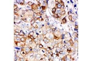 Anti- HSP27 antibody, IHC(P) IHC(P): Human Mammary Cancer Tissue