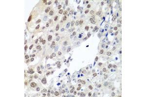 Immunohistochemistry of paraffin-embedded human lung cancer using PTTG1 antibody. (PTTG1 Antikörper  (AA 1-202))