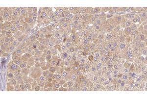 ABIN6272654 at 1/100 staining Human Melanoma tissue by IHC-P.