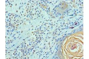 Immunohistochemistry of paraffin-embedded human breast cancer using ABIN7152098 at dilution of 1:100