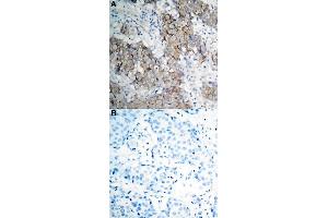 Immunohistochemical staining of human breast cancer tissue by IGF1R (phospho Y1161) polyclonal antibody  without blocking peptide (A) or preincubated with blocking peptide (B) under 1:50-1:100 dilution.