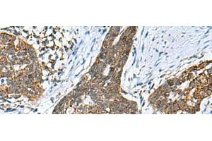 Immunohistochemistry of paraffin-embedded Human esophagus cancer tissue using PREPL Polyclonal Antibody at dilution of 1:55(x200)