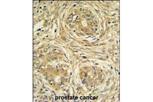 SUPV3L1 Antibody IHC analysis in formalin fixed and paraffin embedded prostate carcinoma followed by peroxidase conjugation of the secondary antibody and DAB staining. (SUPV3L1 Antikörper  (N-Term))