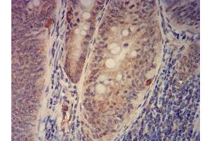 Immunohistochemical analysis of paraffin-embedded rectum cancer tissues using KAT2B mouse mAb with DAB staining. (KAT2B Antikörper  (AA 1-142))