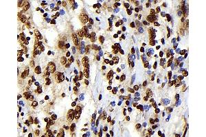 Immunohistochemistry analysis of paraffin-embedded human lymphoma using S100A4 Monoclonal Antibody at dilution of 1:300. (s100a4 Antikörper)
