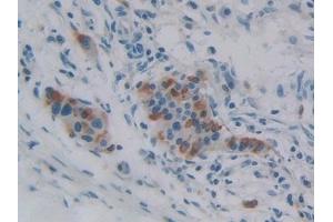 Detection of iPLA2 in Human Pancreatic cancer Tissue using Polyclonal Antibody to Phospholipase A2, Calcium Independent (iPLA2) (PNPLA2 Antikörper  (AA 484-701))