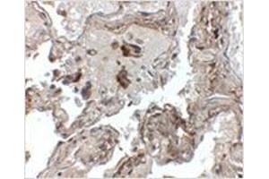 Immunohistochemistry of Transthyretin in human lung tissue with Transthyretin antibody at 2. (TTR Antikörper  (Center))