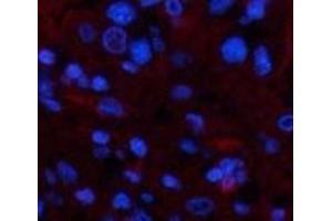 Immunofluorescence analysis of Human liver cancer tissue using TTR Monoclonal Antibody at dilution of 1:200. (TTR Antikörper)