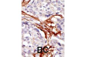Formalin-fixed and paraffin-embedded human cancer tissue reacted with YES1 polyclonal antibody  , which was peroxidase-conjugated to the secondary antibody, followed by AEC staining.