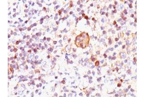 Formalin-fixed, paraffin-embedded human Hodgkin's Lymphoma stained with Bax Mouse Monoclonal Antibody (2D2). (BAX Antikörper  (AA 3-16))