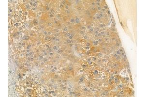 ABIN6257515 and ABIN6275540 at 1/100 staining human hepatocellular carcinoma by IHC-P.