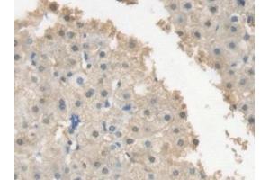 Detection of CRP in Human Liver cancer Tissue using Polyclonal Antibody to C Reactive Protein (CRP) (CRP Antikörper  (AA 17-224))