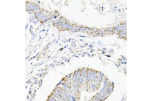 Immunohistochemistry of paraffin-embedded human colon carcinoma using SDC2 antibody at dilution of 1:100 (x40 lens). (Syndecan 2 Antikörper)