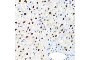 Immunohistochemistry of paraffin-embedded human liver cancer using SSB antibody at dilution of 1:100 (40x lens). (SSB Antikörper)