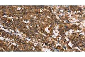 Immunohistochemistry of paraffin-embedded Human gastic cancer using MARC1 Polyclonal Antibody at dilution of 1:40 (MOSC1 Antikörper)