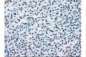 Immunohistochemical staining of paraffin-embedded Adenocarcinoma of breast tissue using anti-BRAF mouse monoclonal antibody. (BRAF Antikörper)