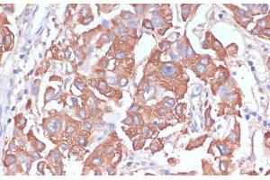 Immunohistochemistry of paraffin-embedded Human liver cancer using LRP1 Polyclonal Antibody at dilution of 1:100 (40x lens). (LRP1 Antikörper)