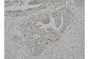 Immunohistochemical analysis of paraffin embedded HUman intestine cancer sections using P73alpha antibody (Tumor Protein p73 Antikörper  (C-Term))