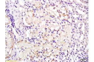 Formalin-fixed and paraffin embedded human laryngeal carcinoma labeled with Anti-FPR1 Polyclonal Antibody, Unconjugated (ABIN742245) at 1:200 followed by conjugation to the secondary antibody and DAB staining (FPR1 Antikörper)